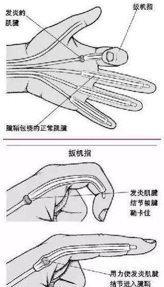 抖音视频:最准一肖一码一一子中特-腱鞘炎是什么症状