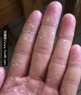 中新网:香港4777777最快开码-手脱皮是什么原因引起的