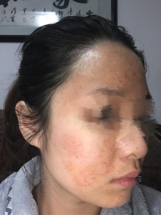 阿里巴巴:老澳六开彩开奖号码记录-什么是脂溢性皮炎