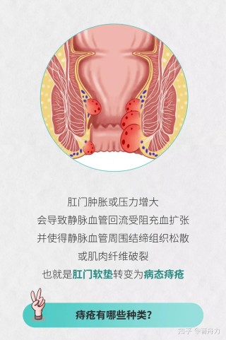 中新网:新澳门王中王资料-什么叫痔疮