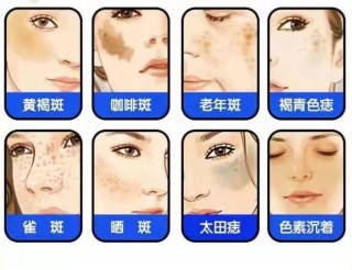 中新网:新澳好彩免费资料查询-黄褐斑是什么样的