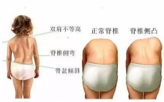 搜狗订阅:管家婆一肖-一码-一中一特-医生呼吁普及中小学生脊柱侧弯筛查