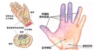 抖音视频:最准一肖一码一一子中特-腱鞘炎是什么症状