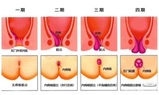 中新网:新澳门王中王资料-什么叫痔疮