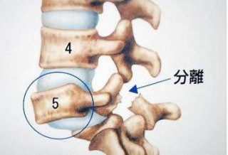 中新网:香港免费资料大全-腰间盘突出怎么缓解