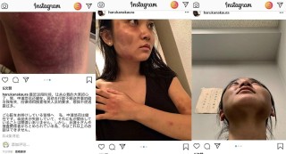 抖音视频:2024澳门正版平特一肖-2年被家暴16次女子左肾严重萎缩