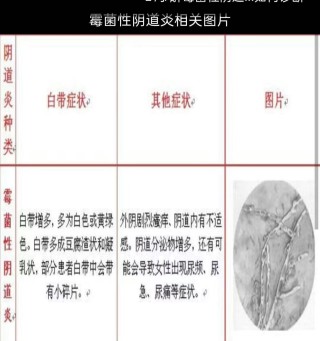 知乎：2024澳门免费精准资料-霉菌性阴炎什么症状