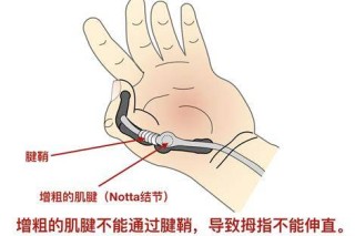 腾讯：正版澳门金牛版资料大全-大拇指腱鞘炎怎么治疗