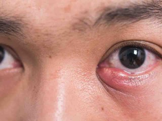 百家号:2o24澳门正版精准资料-麦粒肿是什么引起的