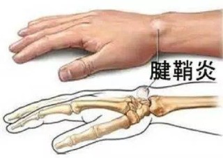 腾讯：正版澳门金牛版资料大全-大拇指腱鞘炎怎么治疗
