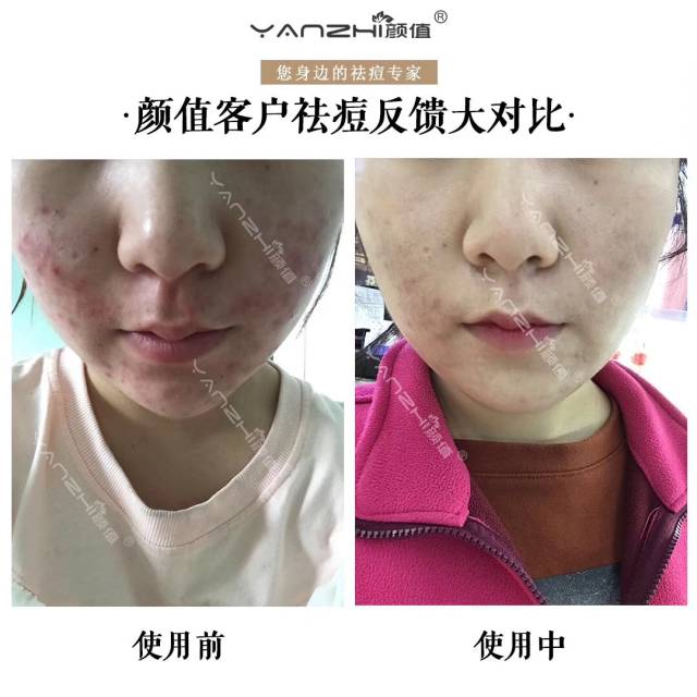 搜狐:澳门4949彩论坛高手-鼻子下面长痘什么原因  第3张