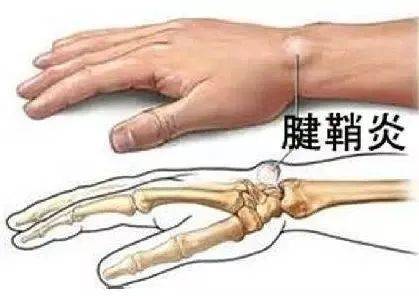 腾讯：正版澳门金牛版资料大全-大拇指腱鞘炎怎么治疗  第2张