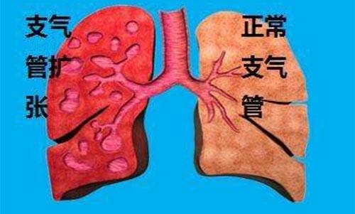 知乎：2024澳门免费最精准龙门客栈-支气管炎什么症状  第3张