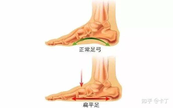 火山视频:澳门一肖一码100%精准王中王-什么是扁平足  第2张