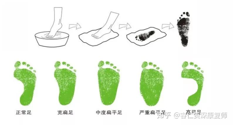 火山视频:澳门一肖一码100%精准王中王-什么是扁平足  第3张