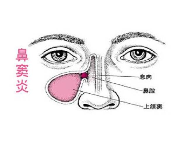 搜狗订阅:4949澳门开奖免费大全49图库-鼻窦炎有什么治疗方法  第3张