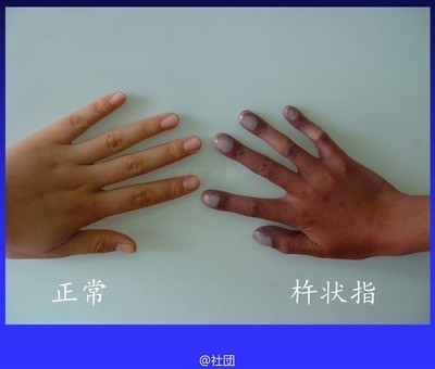 中新网:新澳精准资料免费提供网站有哪些-杵状指见于什么病  第2张