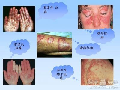 小红书:澳门一码一码100准确-什么人容易得红斑狼疮  第3张