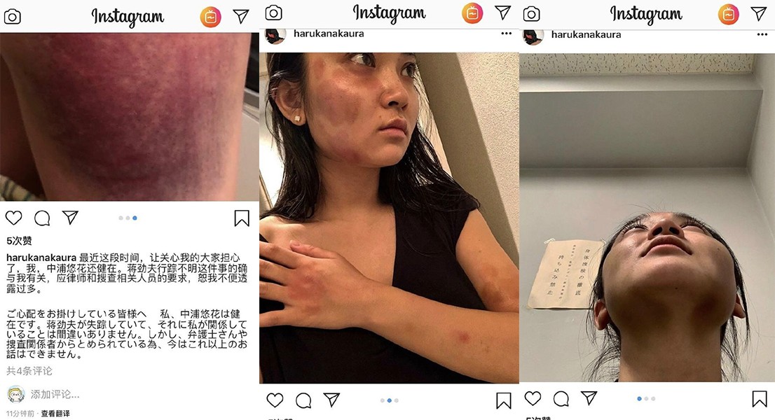 抖音视频:2024澳门正版平特一肖-2年被家暴16次女子左肾严重萎缩  第3张
