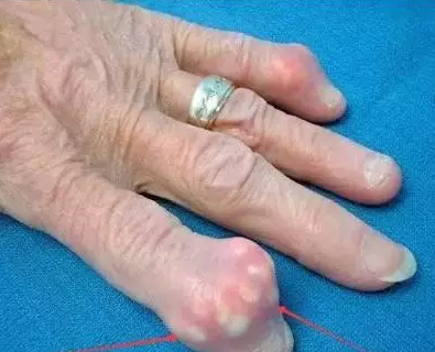 百家号:澳门正版资料大全有哪些-尿酸高是什么原因导致的  第3张
