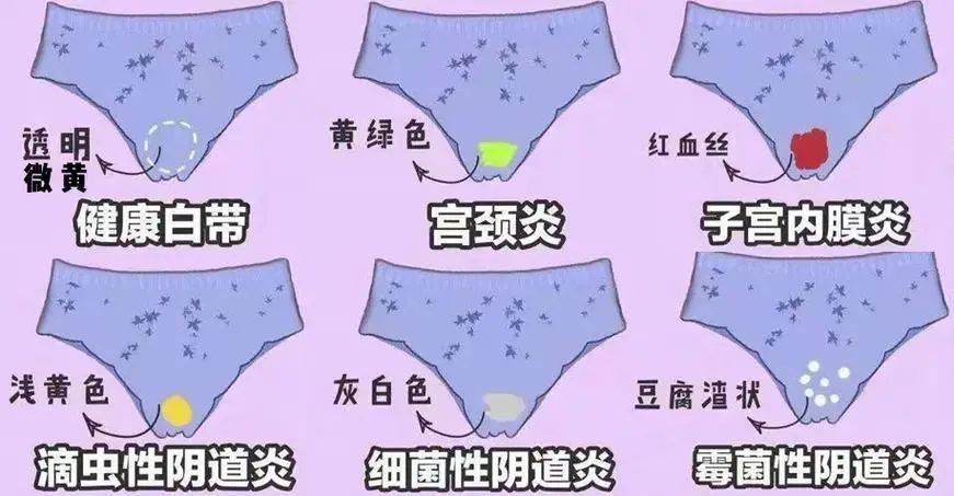 知乎：2024澳门免费精准资料-霉菌性阴炎什么症状  第1张