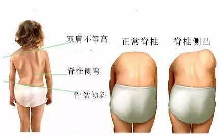 搜狗订阅:管家婆一肖-一码-一中一特-医生呼吁普及中小学生脊柱侧弯筛查  第3张