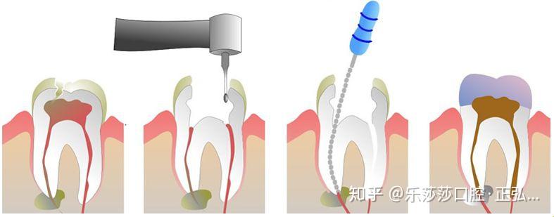 百度平台:白小姐一肖一码100正确-什么是根管治疗  第2张
