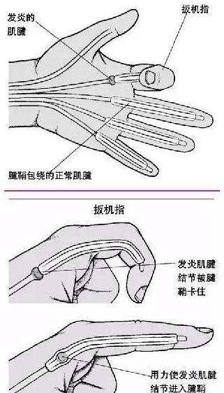 抖音视频:最准一肖一码一一子中特-腱鞘炎是什么症状  第3张
